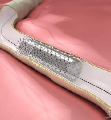 心臟支架并非一勞永逸術(shù)后要注意規(guī)范用藥定期復診